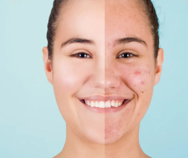 JUSSPRAY for oily skin